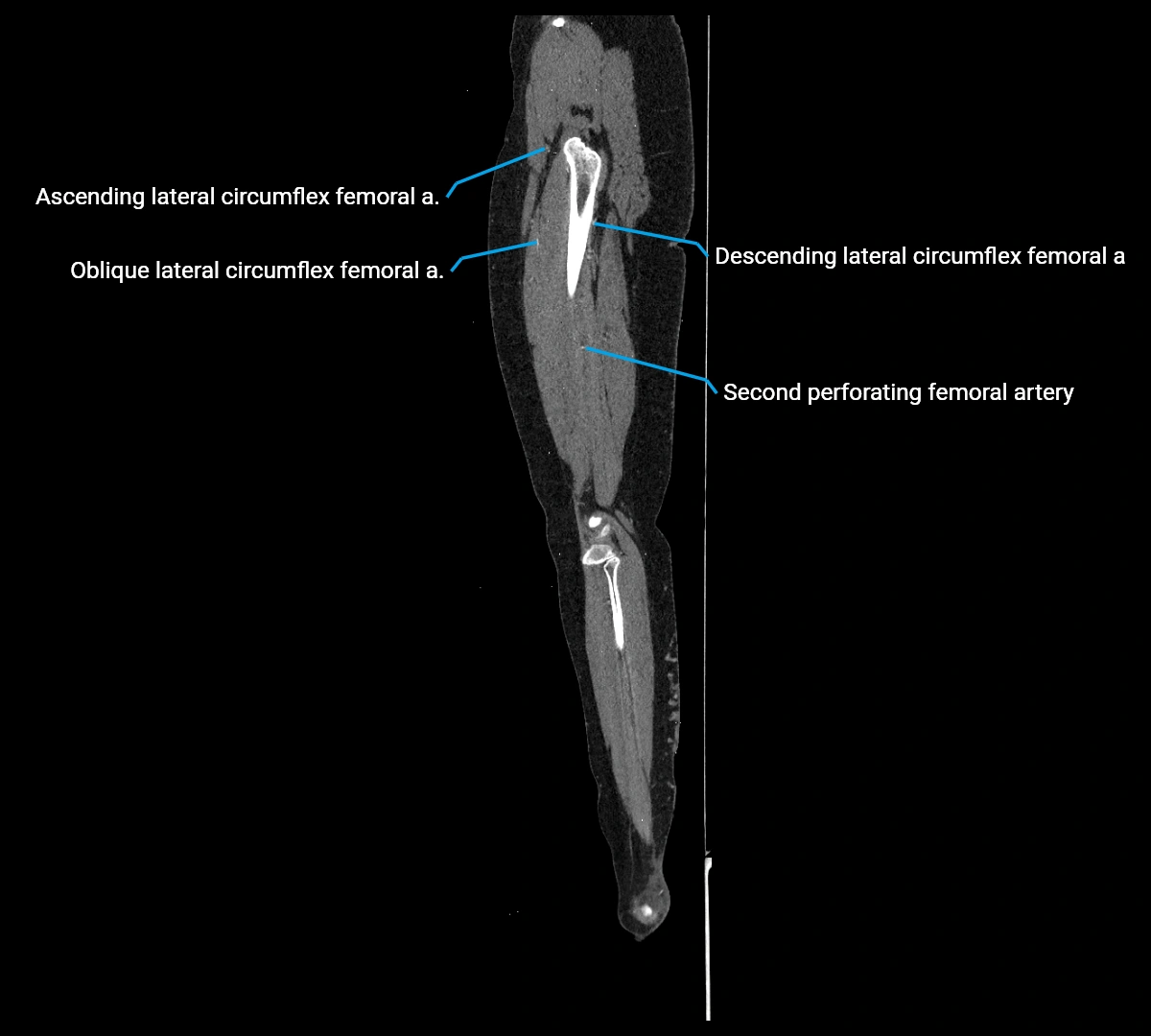 CTA lower limb sagittal cross sectional anatomy labelled image _58 (3).webp